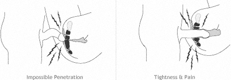 Vaginisme: Causes et symptomes Vaginisme: Causes et symptomes