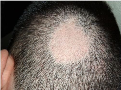 Alopecie 1