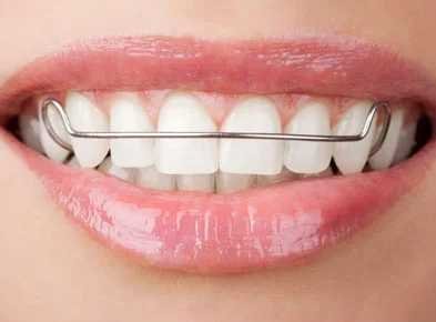 Traitement orthodontique