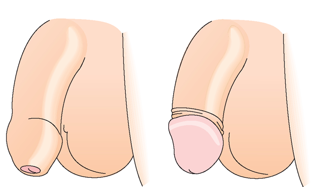 penis circoncris