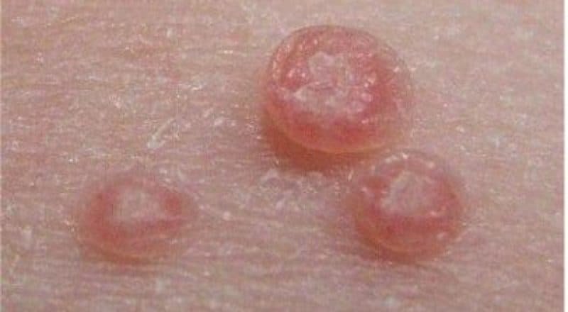 Les verrues genitaless