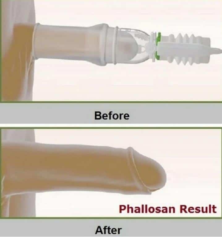 phallosan forte Résultats avant après