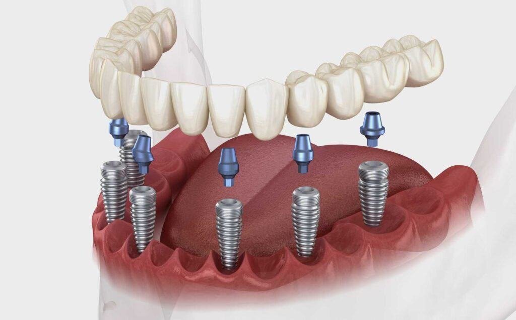 implants dentaires en Turquie