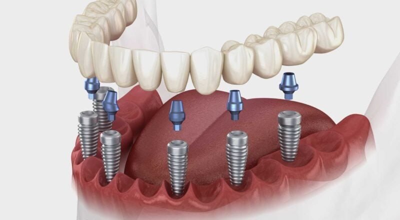 implants dentaires en Turquie