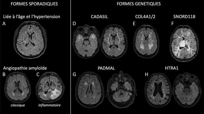 Leucopathie vasculaire Fazekas 2