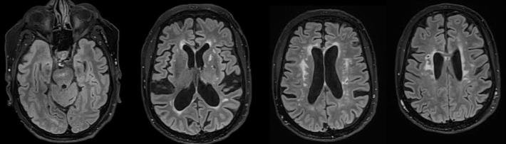 Leucopathie vasculaire
