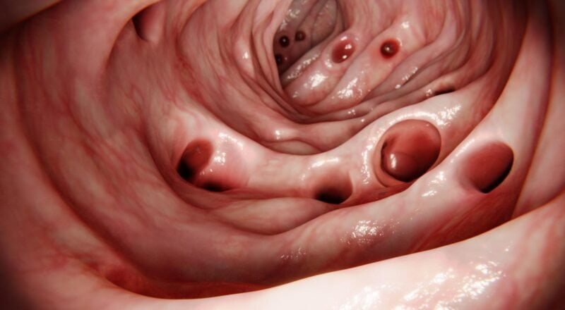 Diverticulite et cause émotionnelle